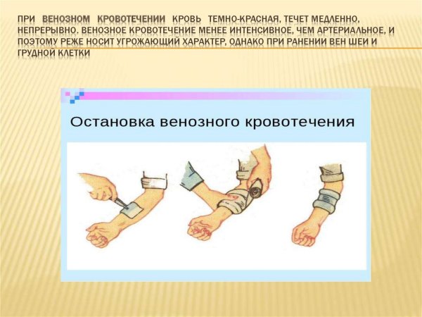 Венознозное кровотечение