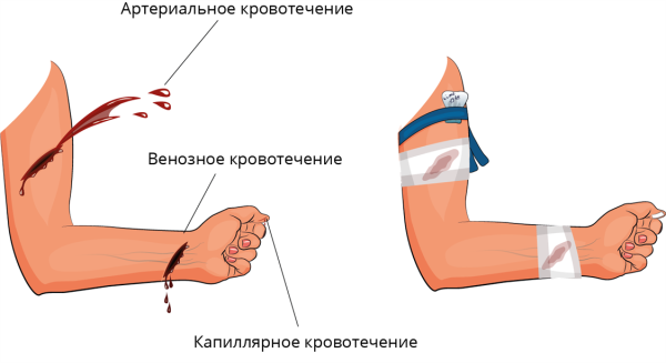 Наружное артериальное кровотечение