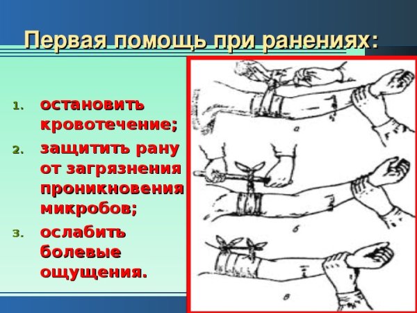 Оказание помощи при кровотечении из раны.