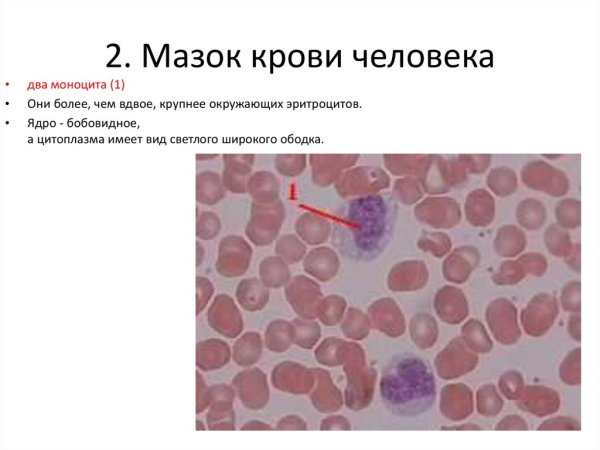 Мазок крови больного малярией