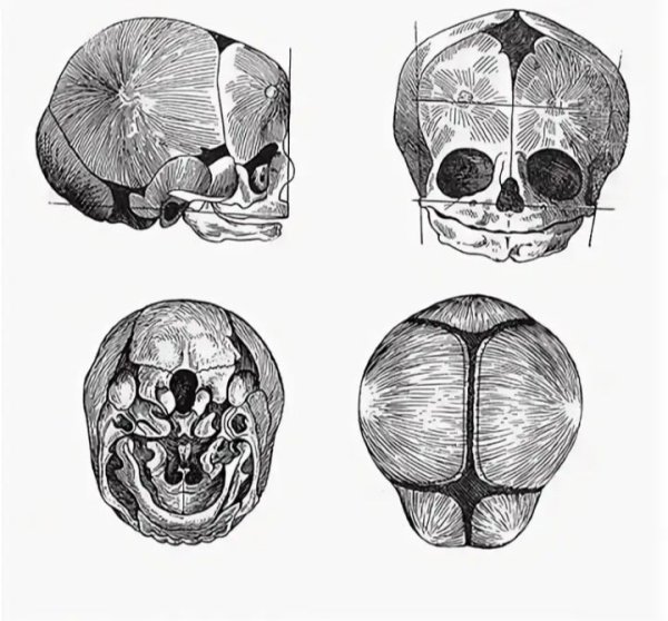 Соединение костей черепа роднички
