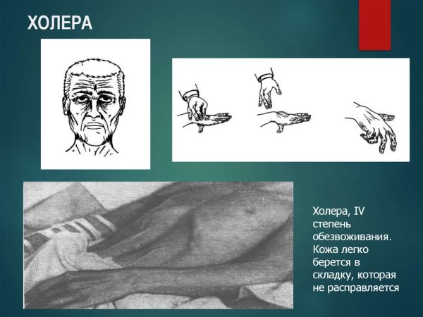 Холера степени обезвоживания