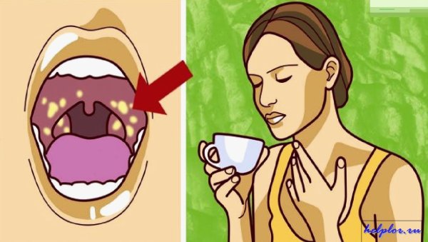 Острый тонзиллит ангина