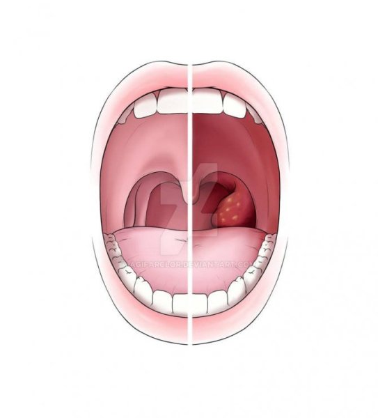 Тонзиллиты фарингиты ларингиты