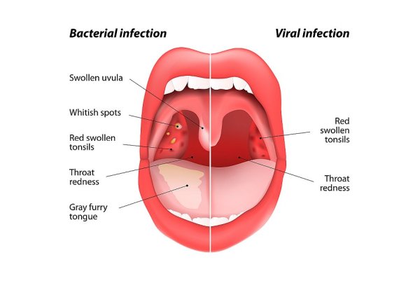 Маленький язычок в горле