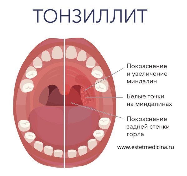 Заболела простудой