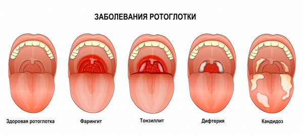Тонзиллит презентация