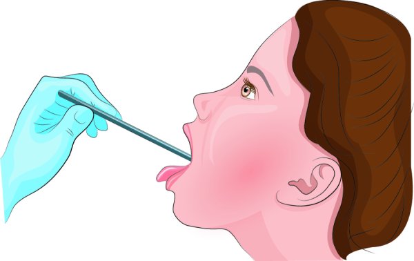 Ангина небных миндалин