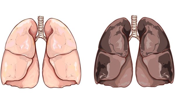 Легкие курильщика и здорового