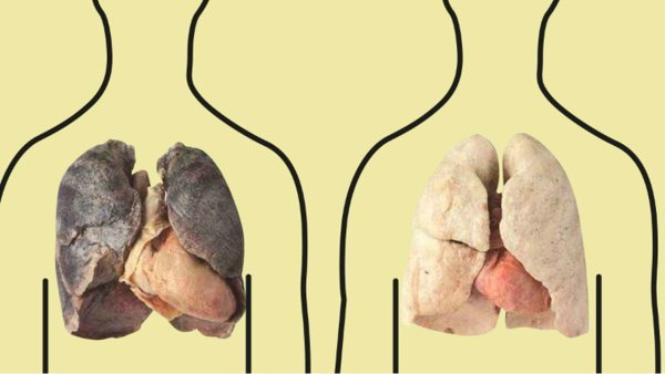 Курение легкие здорового человека и курильщика