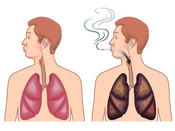 Лёгкие здорового человека и курильщика