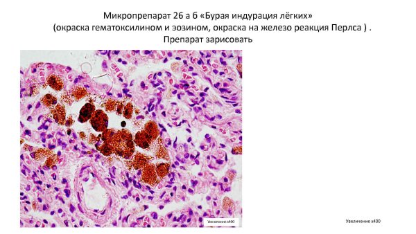 Бурая индурация легкого макропрепарат