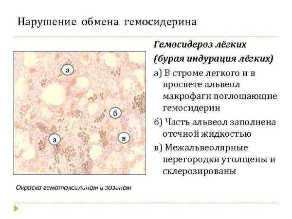Бурая индурация легкого микропрепарат