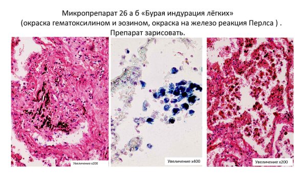 Бурая индурация легких патанатомия