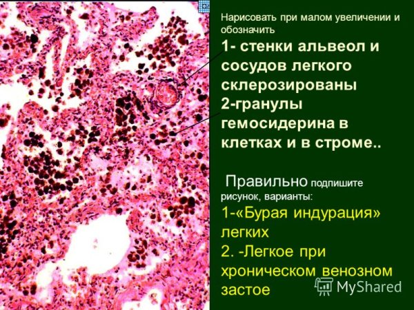 Препарат бурая индурация легких патологическая анатомия