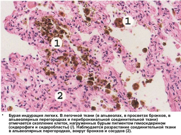 Хроническое венозное полнокровие легких бурая индурация