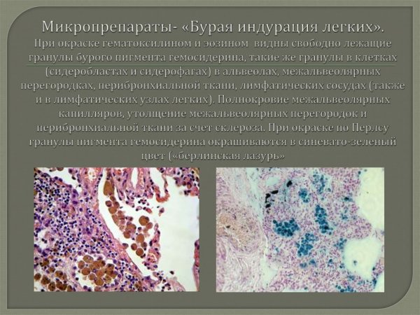 Бурая индурация легкого препарат