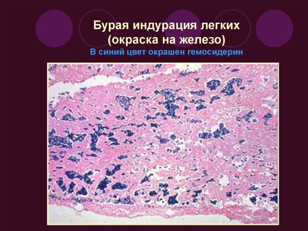 Бурая индурация легких реакция Перлса