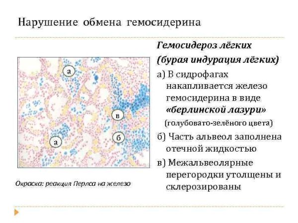 Гемосидероз (бурая индурация)