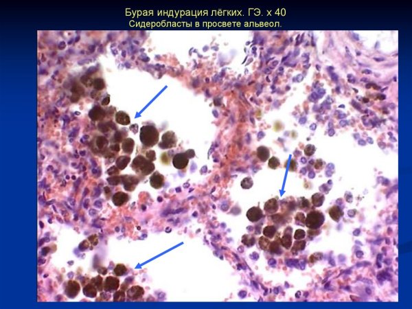 Бурая индурация легкого препарат