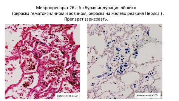 Бурая индурация легких патанатомия