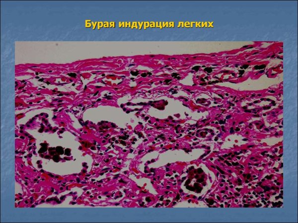 Бурая индурация легких патологическая анатомия