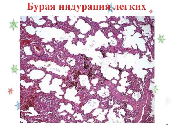 Бурая индурация печени