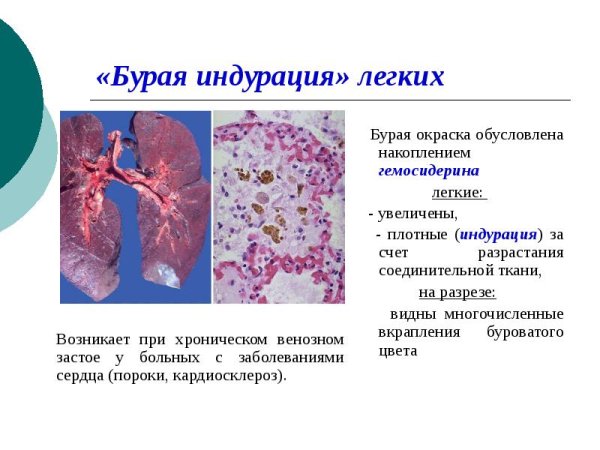 Бурая индурация легкого патанатомия