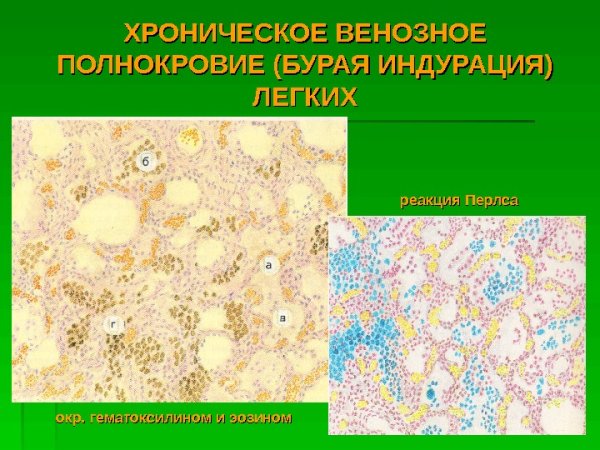 Гемосидероз легкого патологическая анатомия препарат