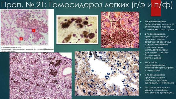 Макропрепарат бурая индурация л