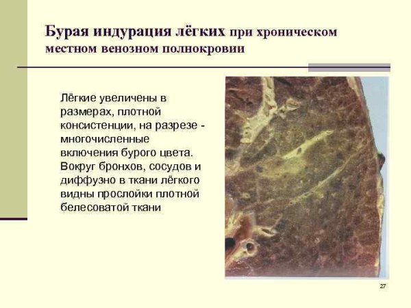 Гемосидероз печени микропрепарат печени