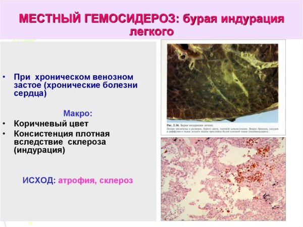 Венозное полнокровие и отек легких микропрепарат