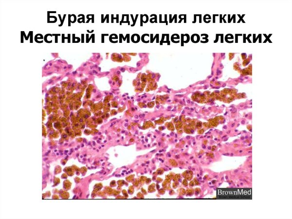 Бурая индурация легких патанатомия