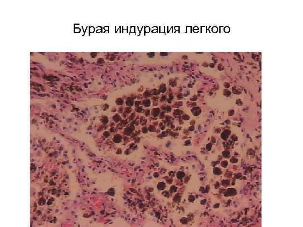 Бурая индурация лёгкого
