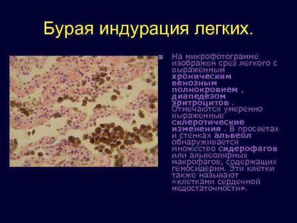 Гемосидероз (бурая индурация)