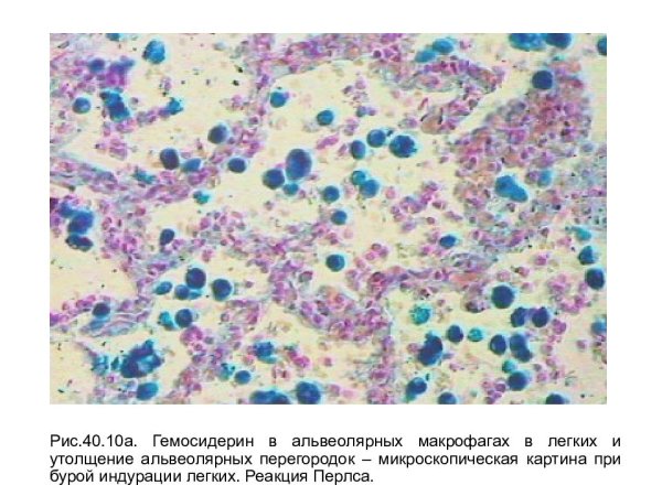 Бурая индурация легких гематоксилин эозин