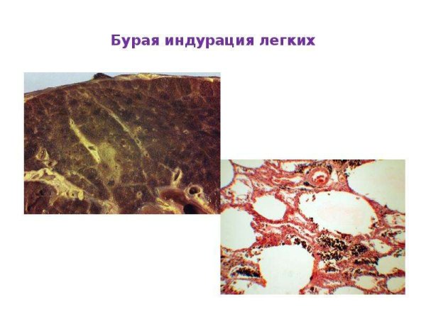 Бурая индурация легкого реакция Перлса