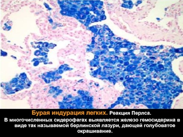 Бурая индурация легкого препарат