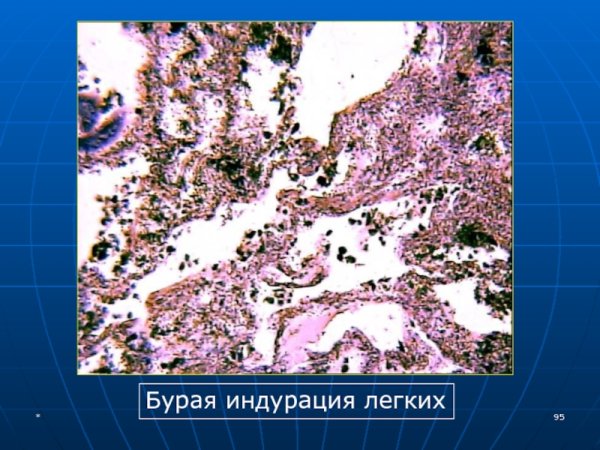 Бурая индурация легких макропрепарат