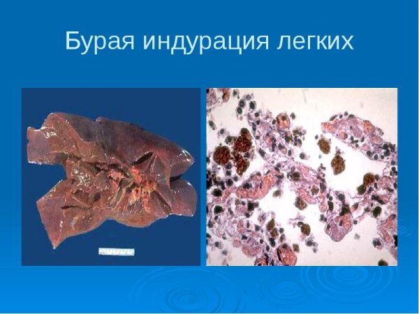 Бурая индурация легких микропрепарат