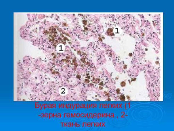 Бурое уплотнение легких макропрепарат