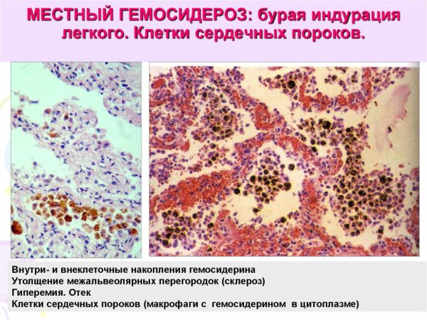 Бурая индурация печени