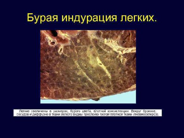 Бурая индурация легких микропрепарат реакция Перлса