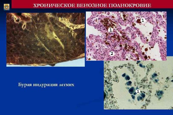 Венозный застой печени микропрепарат