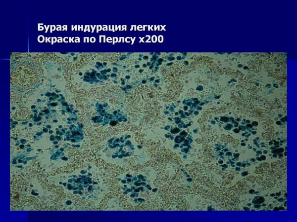 Гемосидероз легких реакция Перлса