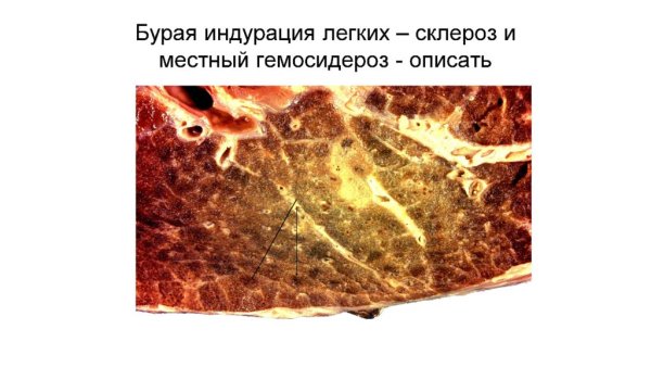 Острое венозное полнокровие патанатомия