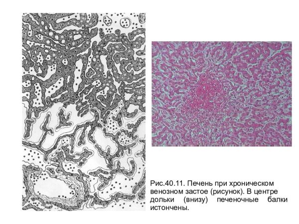 Бурая индурация легких патанатомия