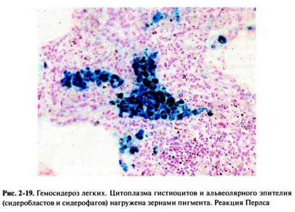 Гемосидероз легких микропрепарат