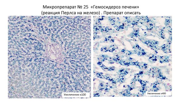 Гемосидероз легкого микропрепарат