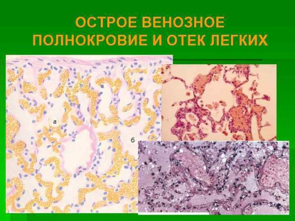 Бурая индурация легких макропрепарат